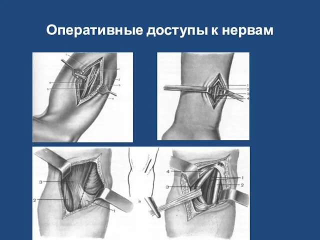 Оперативные доступы к нервам