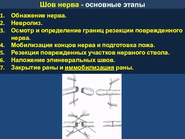 Шов нерва - основные этапы Обнажение нерва. Невролиз. Осмотр и