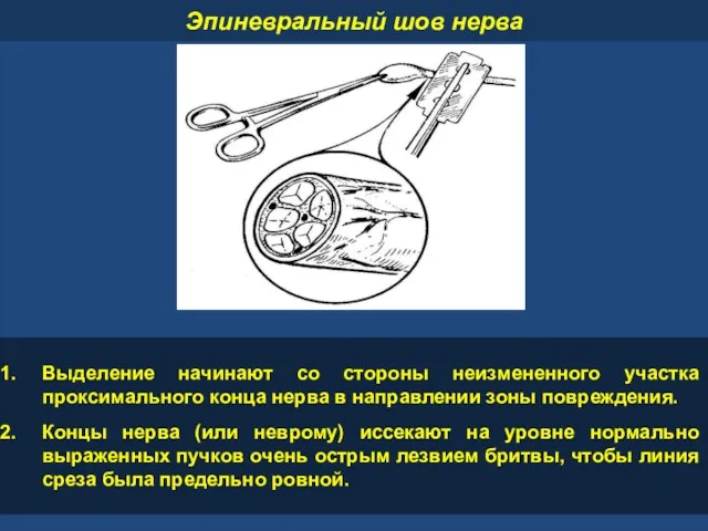 Эпиневральный шов нерва Выделение начинают со стороны неизмененного участка проксимального