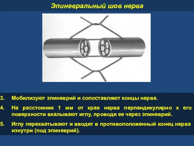 Мобилизуют эпиневрий и сопоставляют концы нерва. На расстоянии 1 мм