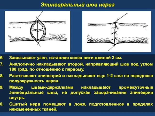 Завязывают узел, оставляя конец нити длиной 3 см. Аналогично накладывают