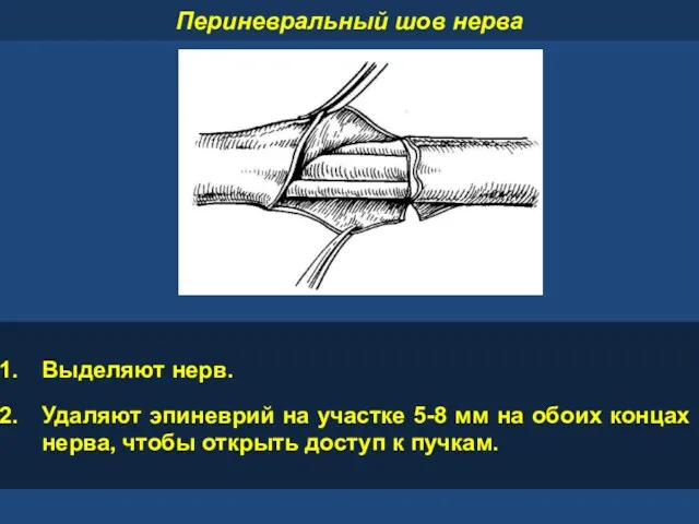 Периневральный шов нерва Выделяют нерв. Удаляют эпиневрий на участке 5-8