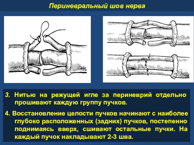 3. Нитью на режущей игле за периневрий отдельно прошивают каждую