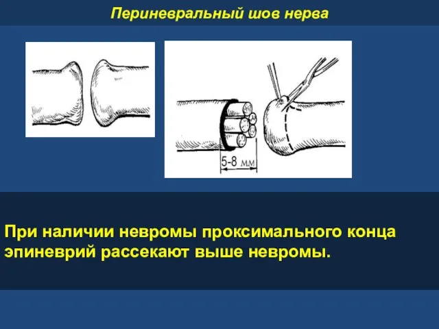 При наличии невромы проксимального конца эпиневрий рассекают выше невромы. Периневральный шов нерва