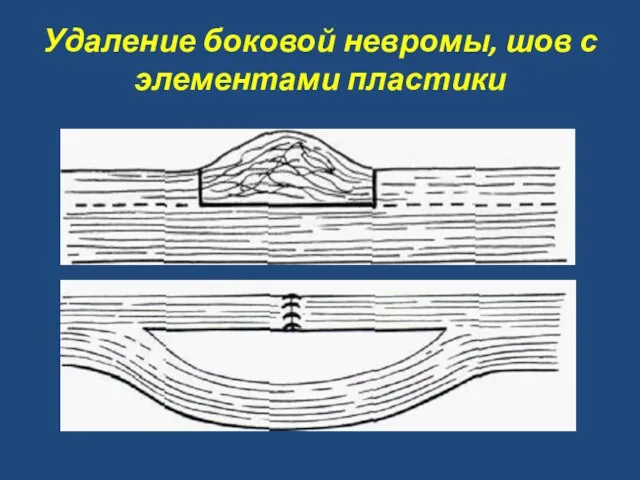 Удаление боковой невромы, шов с элементами пластики