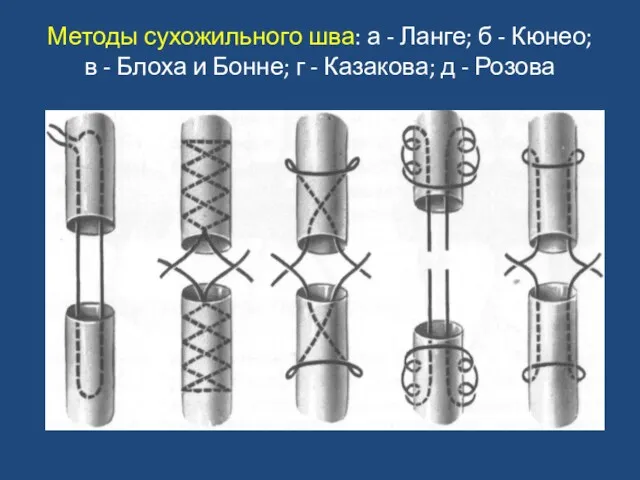 Методы сухожильного шва: а - Ланге; б - Кюнео; в