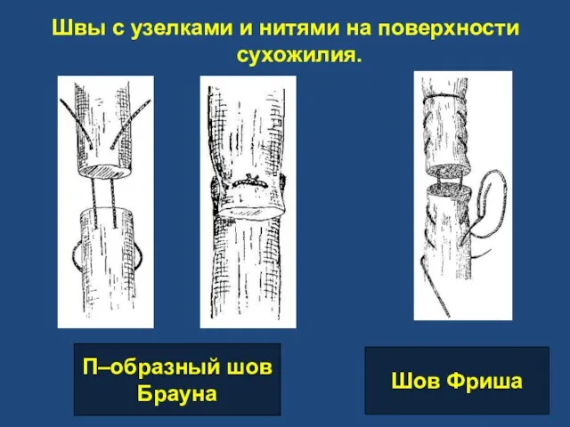 Швы с узелками и нитями на поверхности сухожилия. П–образный шов Брауна Шов Фриша