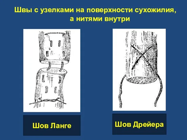 Швы с узелками на поверхности сухожилия, а нитями внутри Шов Ланге Шов Дрейера