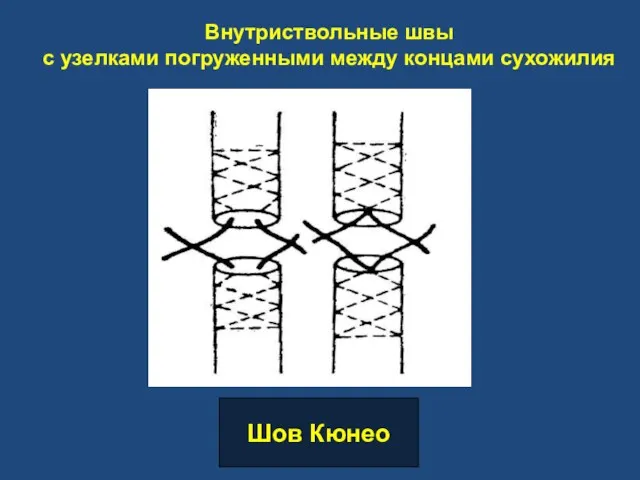 Внутриствольные швы с узелками погруженными между концами сухожилия Шов Кюнео