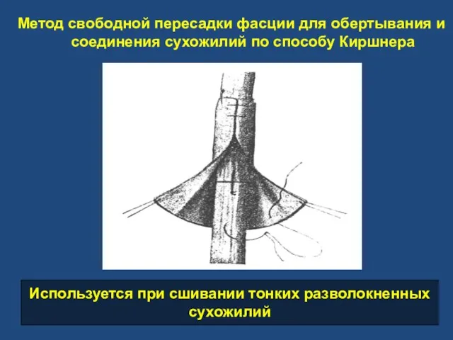 Метод свободной пересадки фасции для обертывания и соединения сухожилий по