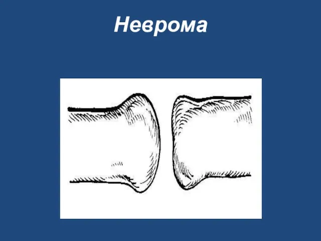 Неврома