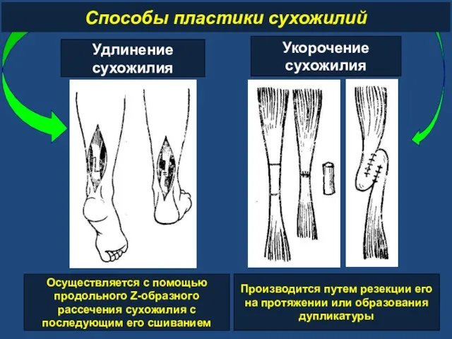 Способы пластики сухожилий Удлинение сухожилия Укорочение сухожилия Осуществляется с помощью