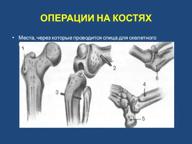 ОПЕРАЦИИ НА КОСТЯХ Места, через которые проводится спица для ске­летного вытяжения