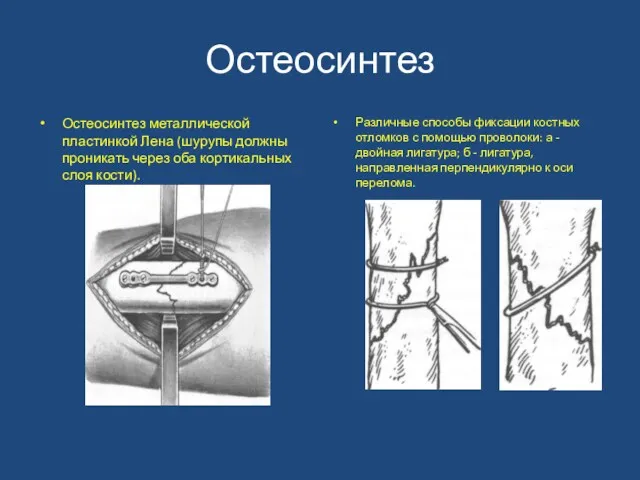 Остеосинтез Остеосинтез металлической пластинкой Лена (шу­рупы должны проникать через оба