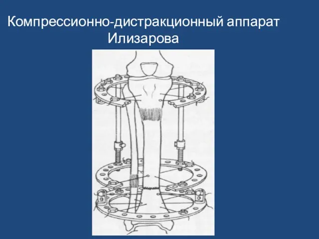 Компрессионно-дистракционный аппарат Илизарова