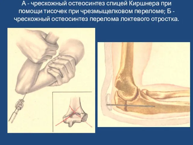 А - чрескожный остеосинтез спицей Киршнера при помощи тисочек при