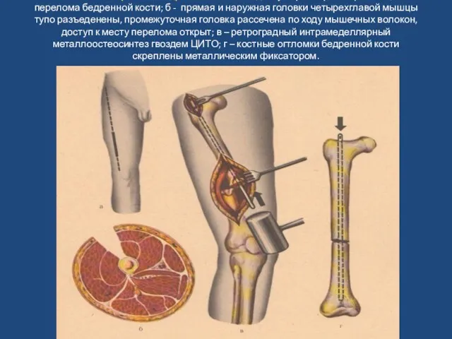 Остеосинтез перелома бедренной кости: а – доступ при открытой репозиции