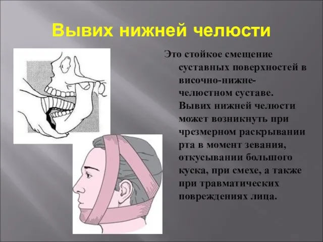 Вывих нижней челюсти Это стойкое смещение суставных поверхностей в височно-нижне-челюстном