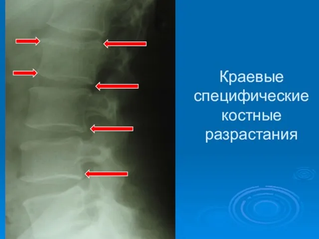 Краевые специфические костные разрастания