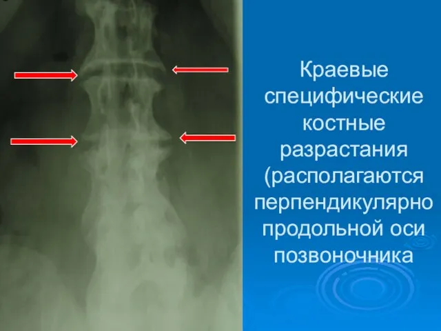 Краевые специфические костные разрастания (располагаются перпендикулярно продольной оси позвоночника