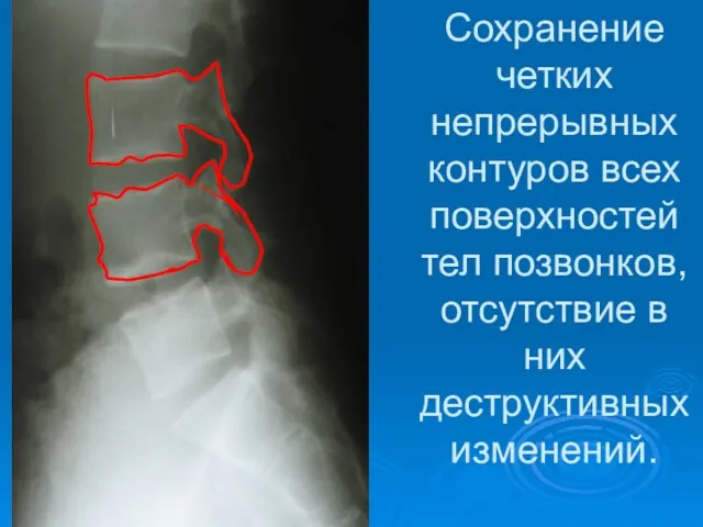 Сохранение четких непрерывных контуров всех поверхностей тел позвонков, отсутствие в них деструктивных изменений.