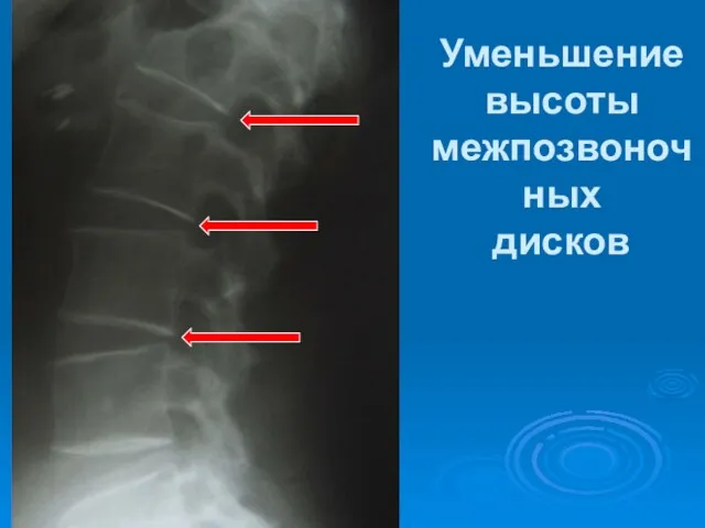 Уменьшение высоты межпозвоночных дисков