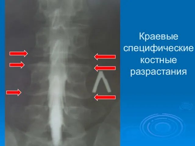 Краевые специфические костные разрастания