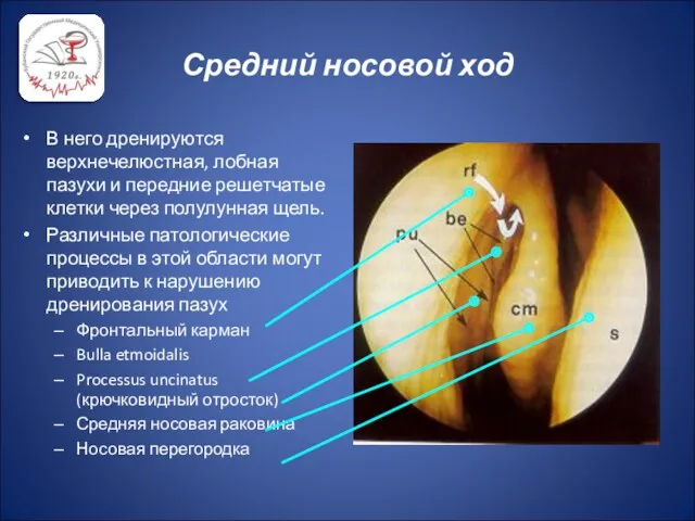 Средний носовой ход В него дренируются верхнечелюстная, лобная пазухи и