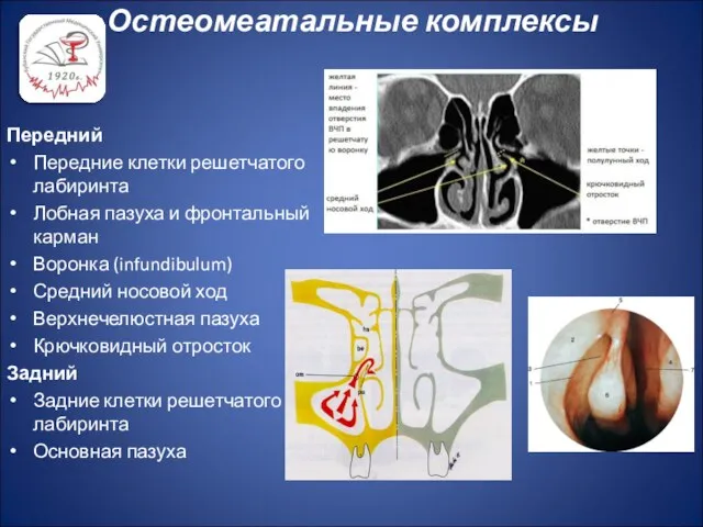 Остеомеатальные комплексы Передний Передние клетки решетчатого лабиринта Лобная пазуха и