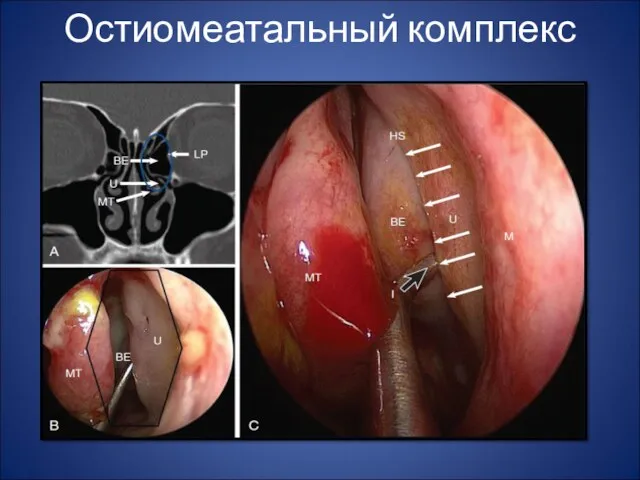 Остиомеатальный комплекс