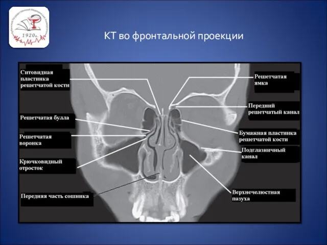 КТ во фронтальной проекции