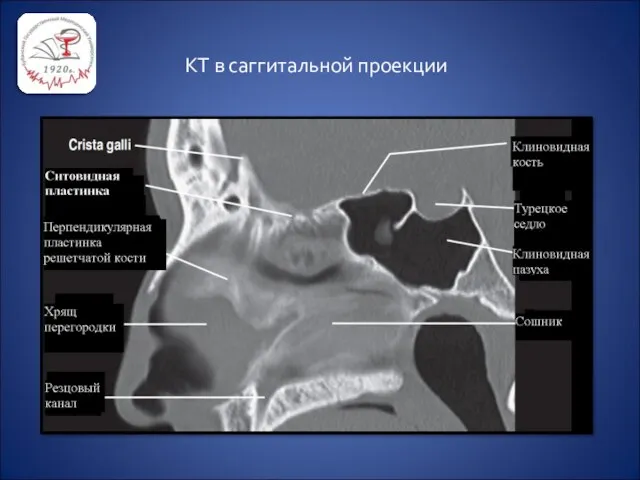 КТ в саггитальной проекции