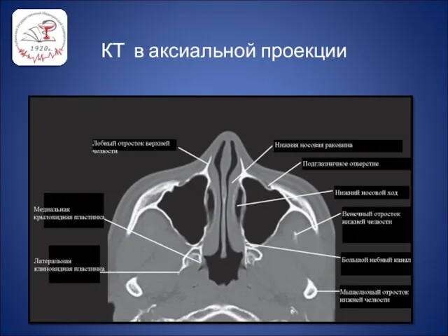 КТ в аксиальной проекции