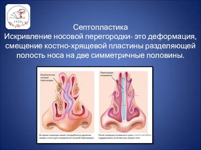 Септопластика Искривление носовой перегородки- это деформация, смещение костно-хрящевой пластины разделяющей полость носа на две симметричные половины.