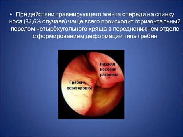 При действии травмирующего агента спереди на спинку носа (32,6% случаев)