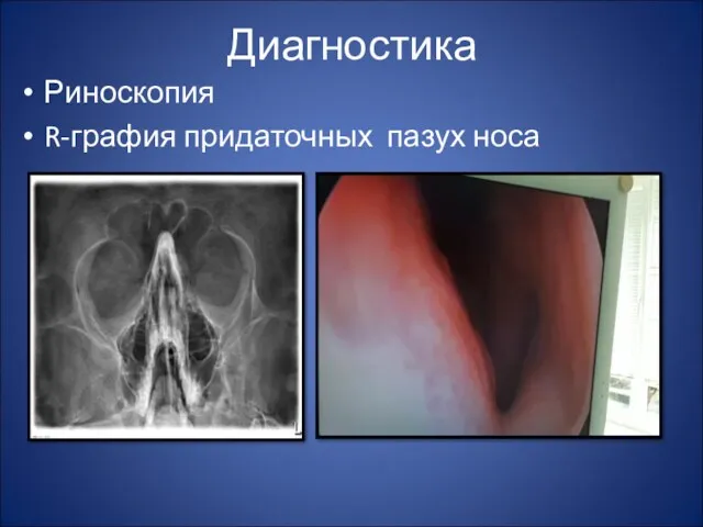 Диагностика Риноскопия R-графия придаточных пазух носа