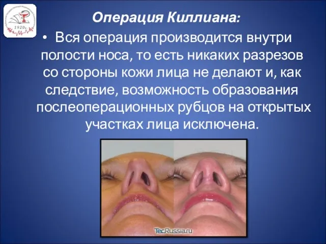 Операция Киллиана: Вся операция производится внутри полости носа, то есть