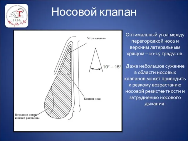 Носовой клапан Оптимальный угол между перегородкой носа и верхним латеральным