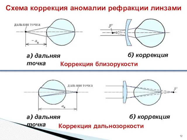 Схема коррекция аномалии рефракции линзами а) дальняя точка б) коррекция