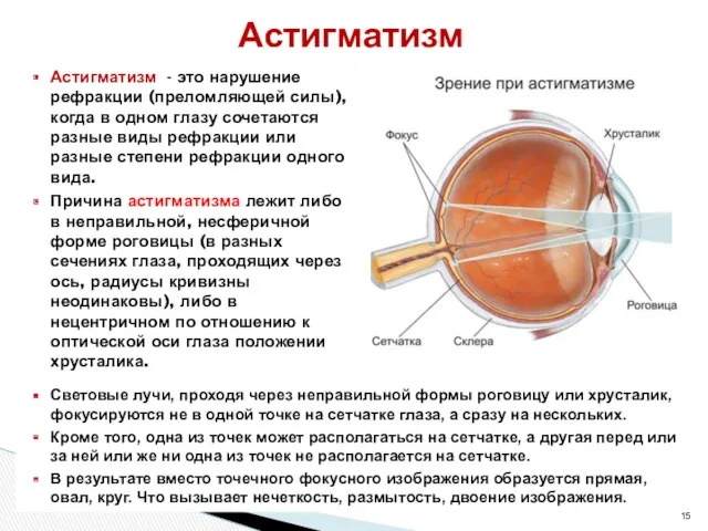 Астигматизм - это нарушение рефракции (преломляющей силы), когда в одном