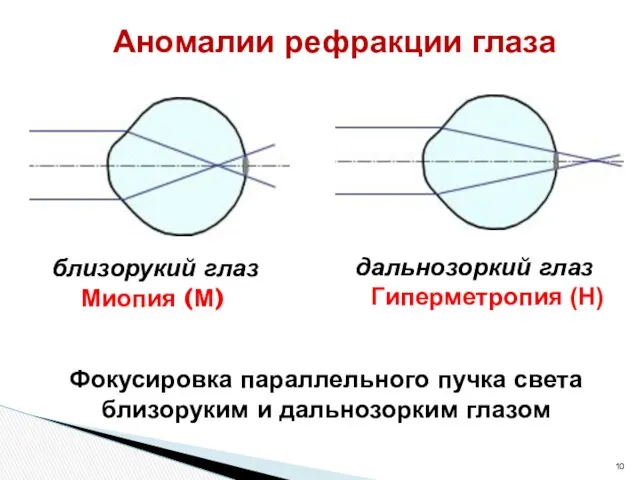 Аномалии рефракции глаза близорукий глаз Миопия (М) дальнозоркий глаз Гиперметропия (Н) Фокусировка параллельного