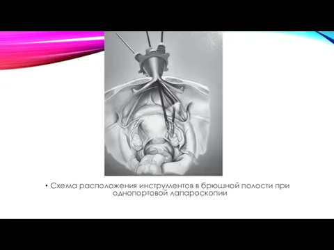 Схема расположения инструментов в брюшной полости при однопортовой лапароскопии