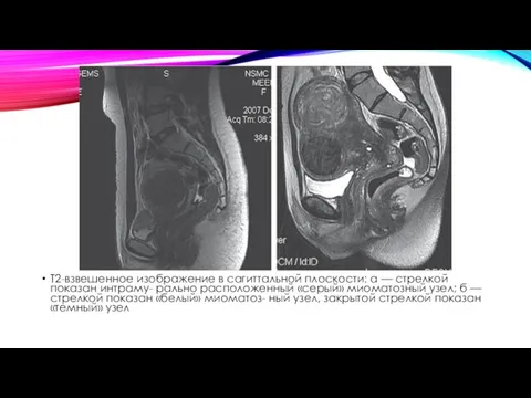 Т2-взвешенное изображение в сагиттальной плоскости: а — стрелкой показан интраму-