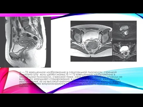 а — Т2-взвешенное изображение в сагиттальной плоскости, стрелкой показана опу-