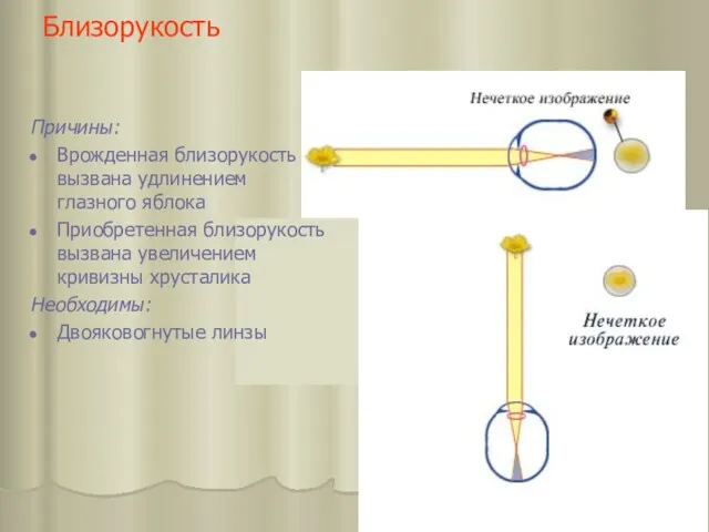 Близорукость Причины: Врожденная близорукость вызвана удлинением глазного яблока Приобретенная близорукость