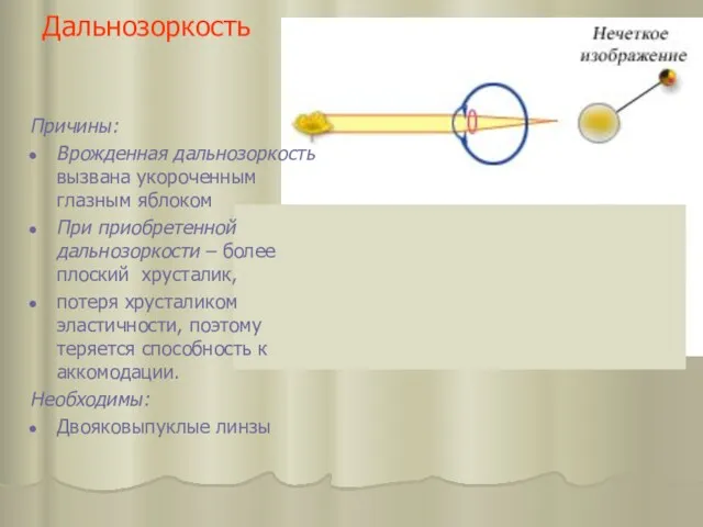 Дальнозоркость Причины: Врожденная дальнозоркость вызвана укороченным глазным яблоком При приобретенной