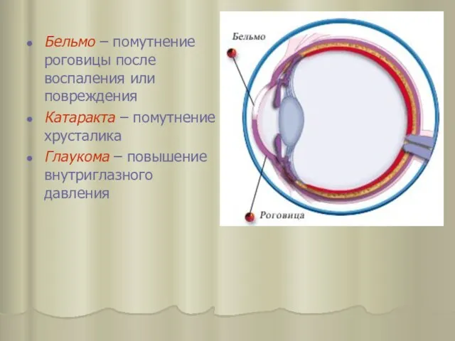 Бельмо – помутнение роговицы после воспаления или повреждения Катаракта –