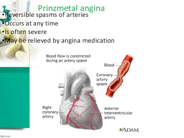 Prinzmetal angina Reversible spasms of arteries Occurs at any time