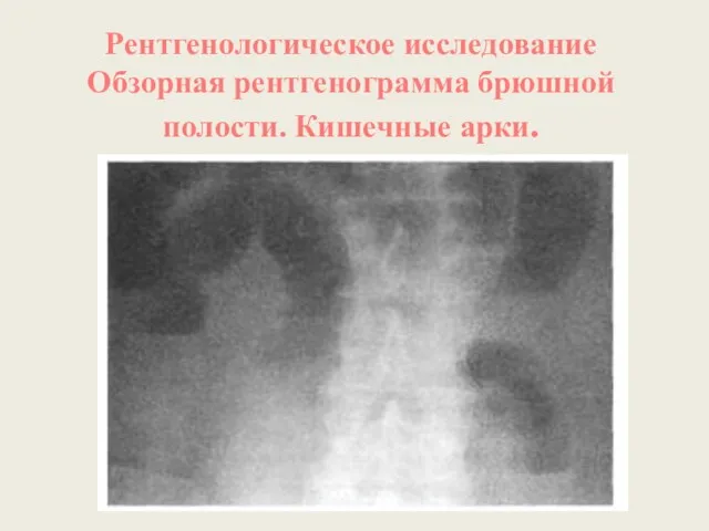 Рентгенологическое исследование Обзорная рентгенограмма брюшной полости. Кишечные арки.