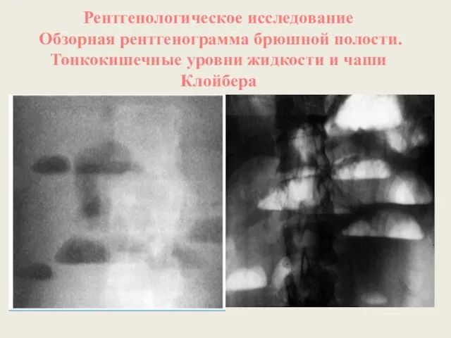 Рентгенологическое исследование Обзорная рентгенограмма брюшной полости. Тонкокишечные уровни жидкости и чаши Клойбера